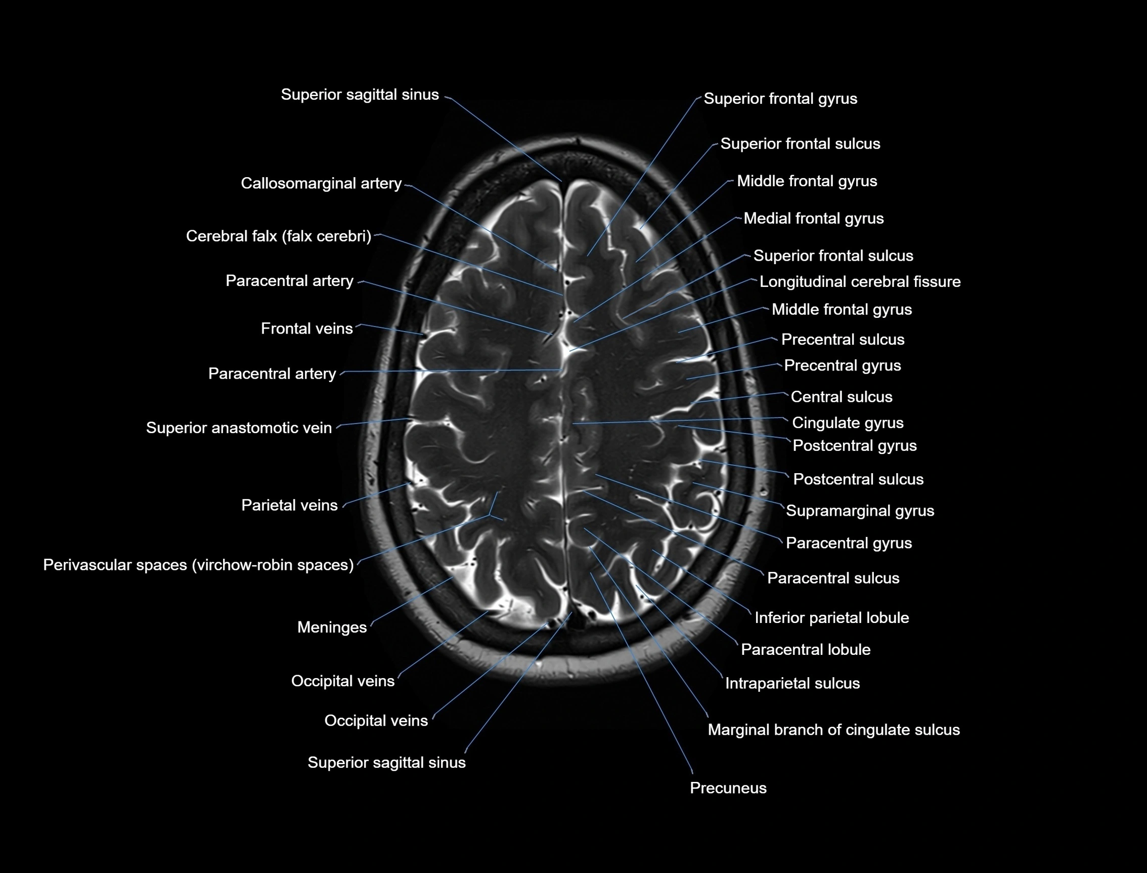 MRI Brain axial cross sectional radiology anatomy 3T image  -img-00001-00045.webp